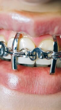 Close-up of teeth with metal dental braces showing the orthodontic correction process. The metal brackets and wires are clearly visible against the white teeth and pink gums.