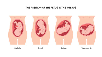 Different baby positions in the womb during pregnancy, Cephalic, Breech, transverse, Oblique lies. Colored medical poster, banner. Fetus, Unborn Baby