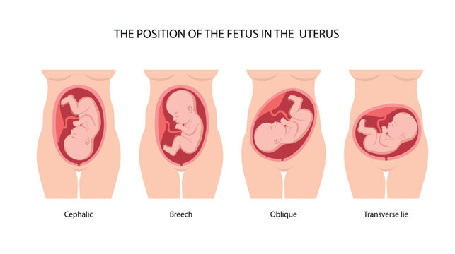 Different baby positions in the womb during pregnancy, Cephalic, Breech, transverse, Oblique lies. Colored medical poster, banner. Fetus, Unborn Baby