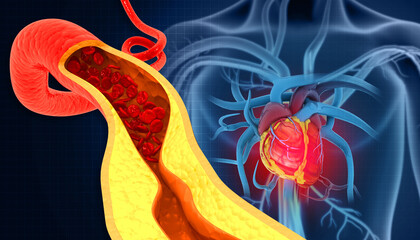 Cholesterol blocked artery with heart. 3d illustration