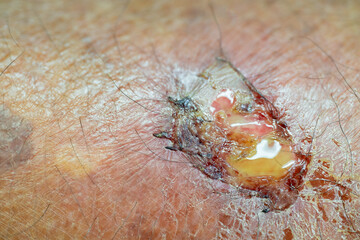 Close up of infected skin wound with pus and inflammation. Medical concept for skin infection,...
