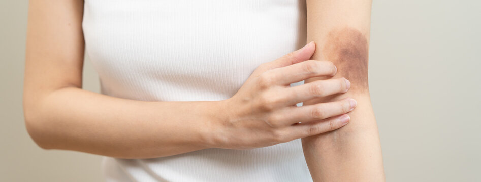Close up of stain bruise wound on arm, contusion asian young woman, girl an accident fell down stairs, hand on elbow in healing injury by massage hematoma blood