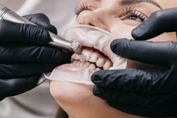 Professional teeth cleaning in a modern dental clinic, close-up. Conceptual dentistry, teeth...