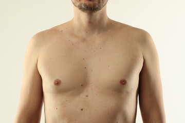 Fototapeta premium Man with moles on his skin against light background, closeup