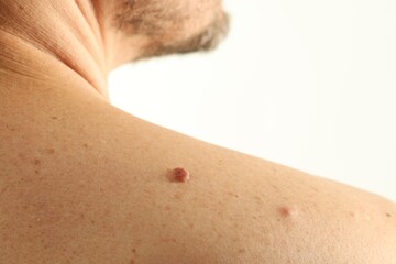 Naklejka premium Man with mole on his skin against light background, closeup