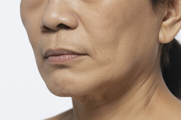 肌のトラブル 日本人女性 クローズアップ（スキンケア シミ 二キビ 赤み たるみ ゆるみ ）