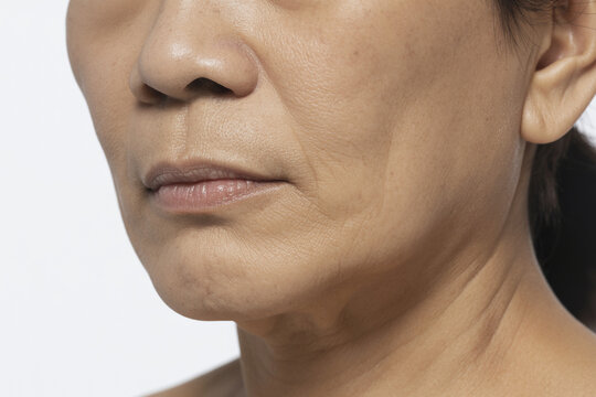 肌のトラブル 日本人女性 クローズアップ（スキンケア シミ 二キビ 赤み たるみ ゆるみ ）