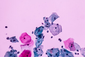 Abnormal squamous epithelial cells on white background view in microscopy.Atypical epithelial cells...