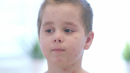 A child with a skin condition chickenpox being photographed in a bright and cheerful environment