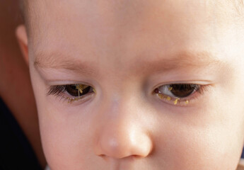 Little boy with pus in his eyes, the boy's disease is bacterial conjunctivitis. Viral infection in the eyes, close-up