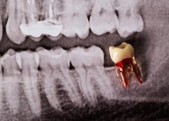 artificial wisdom tooth against the background of an extracted wisdom tooth in an x-ray image, close-up