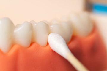 Taking a bacteriological smear from the gingival canal for staphylococci and streptococci bacteria, macro