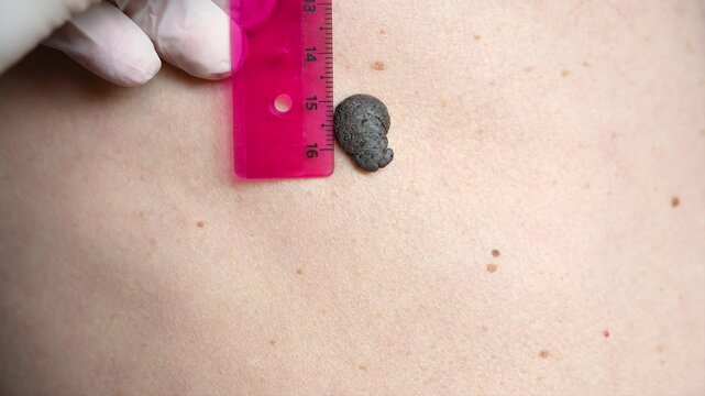 Measuring the size of a convex black birthmark on the body