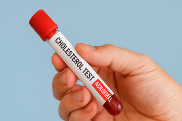 Hand holding cholesterol test blood sample tube with abnormal label, concept of medical analysis, heart health, lipid screening, blood testing, diagnosis and cardiovascular care

