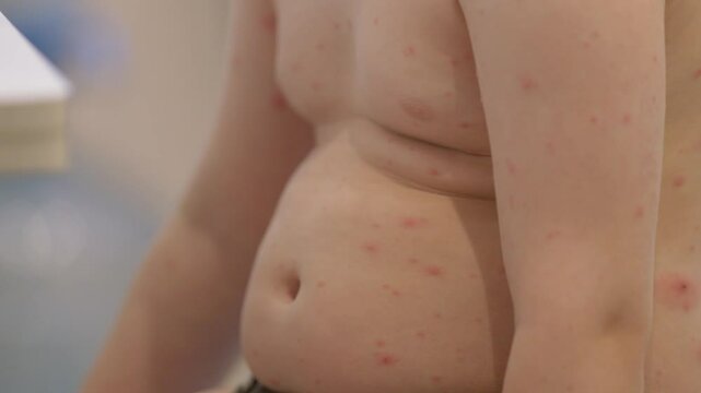 A Childs Skin Condition chickenpox Featuring Pink Bumps and Rashes Needs Proper Care and Attention