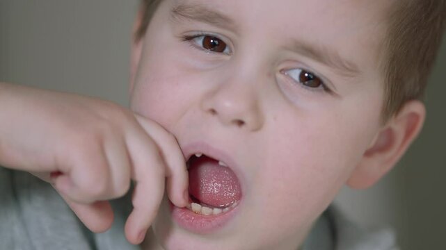 Child Opens His Mouth To Show Wiggling Baby Tooth. Child Showing His Milk Tooth Before Losing It. Permanent Tooth Replacement.