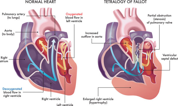 Illustration showing a normal heart and one with symptoms of Tetralogy of Fallot, a cardiovascular disease, with annotations.