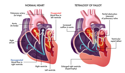 Illustration showing a normal heart and one with symptoms of Tetralogy of Fallot, a cardiovascular disease, with annotations.