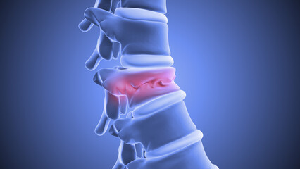 Vertebroplasty or Spinal Vertebrae Stabilization Using Bone Cement