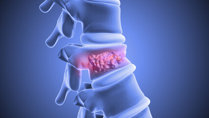 Vertebroplasty or Spinal Vertebrae Stabilization Using Bone Cement