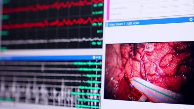 Instrument touches the operated brain on the monitor of computer. Brain waves run beside. Close up. Equipment working at neurosurgery.
