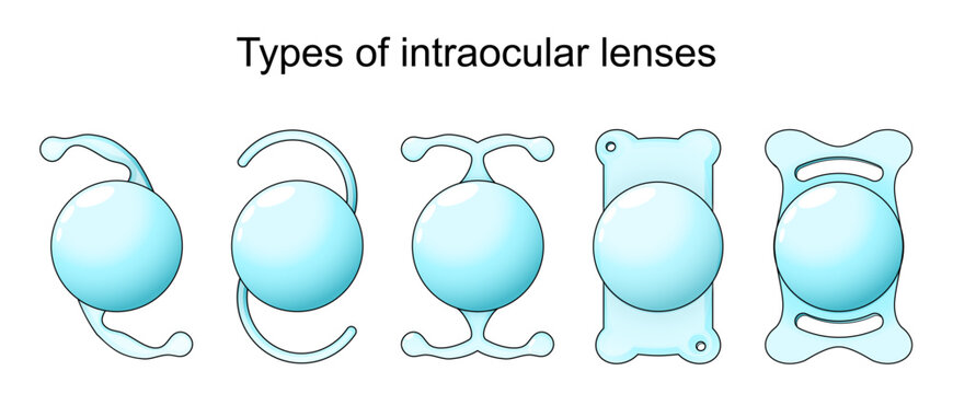 Types of intraocular lenses in Cataract surgery.