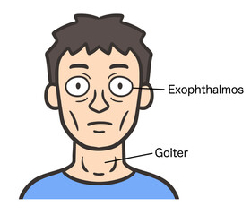 バセドウ病の症状が出ている男性の顔