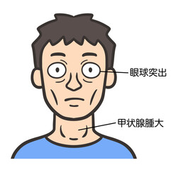 バセドウ病の症状が出ている男性の顔