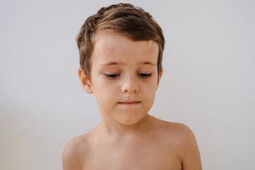 Coxsackie virus. Symptom of hand, ears, foot and mouth. Painful rash red spots blisters on the mouth