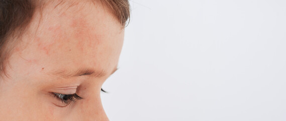 Close-up of the face of a child infected with the Coxsackie virus. Spots, Blisters and a rash on...