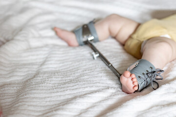 Infant's foot secured in a Wilensky splint, designed for treating hip dysplasia. The splint aids in...