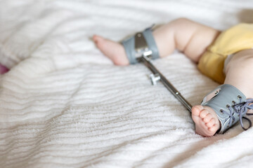 Infant's foot secured in a Wilensky splint, designed for treating hip dysplasia. The splint aids in...