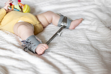 Infant Wearing Wilensky Splint for Hip Dysplasia Treatment