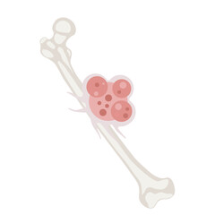 Bone cancer like osteosarcoma and adamantinoma affects bones; related tumors include Ewing sarcoma and chondrosarcoma.diagnosis aids treatment and improves outcomes