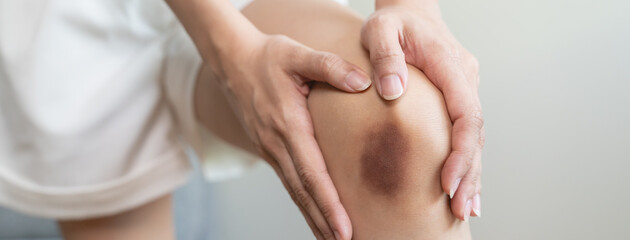 Close up of stain bruise wound on leg, contusion asian young woman, girl on joint knee from an...