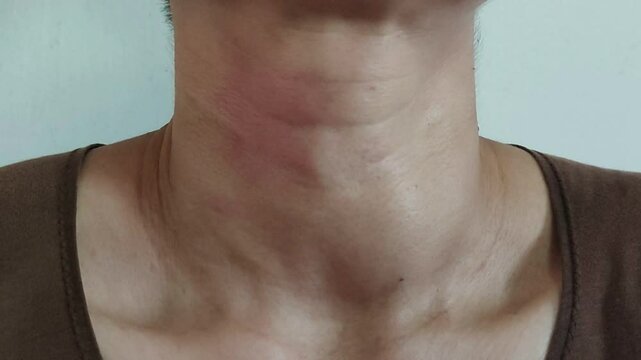 Swallowing Difficulty as a result of Enlargement of Cyst at Thyroid Gland, which is a Symptom of Thyroid Disorders called Graves&rsquo; Disease