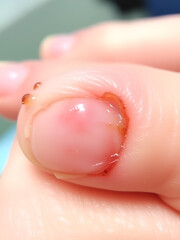 Fototapeta premium Fingernail bed inflammation, bacterial infection