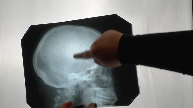 X-ray of the skull in profile.
lateral X-ray of the human skull. The doctor examines the X-ray of the human skull in profile.