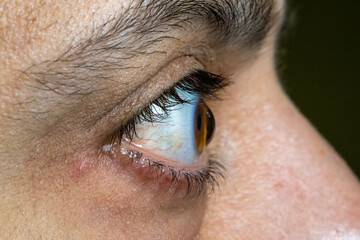 Macro close-up of a human right eye with advanced keratoconus. Visible corneal thinning, conical...