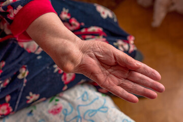 An elderly woman with a crooked arm with a fracture, an improperly fused fracture of the bones of...