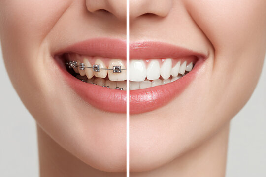 See the incredible before and after of a smile transformed by braces.