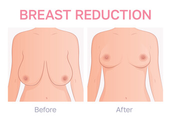 Vector illustration showing comparison  between before and after breast reduction mammaplasty. Breast ptosis treatment.