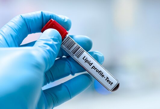 Blood sample tube for lipid profile test analysis. 