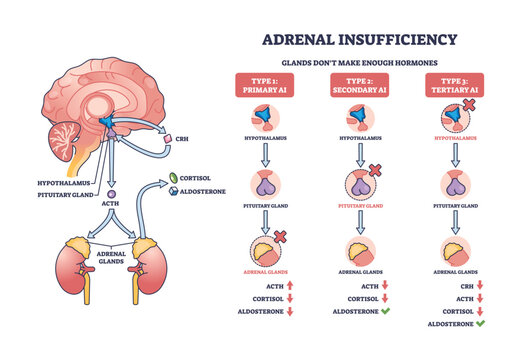 Adrenal insufficiency diagram shows hormone pathways, highlighting brain, adrenal glands, and hormone flow. Outline diagram