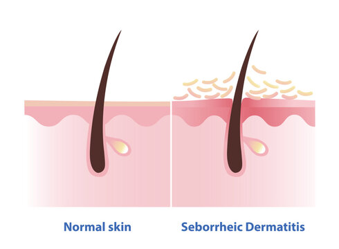 Comparison of normal skin and Seborrheic Dermatitis illustration. Cross section of Sebderm, inflamed, red patches with a greasy scale and flakes over of the skin. Skin care and disorder concept.