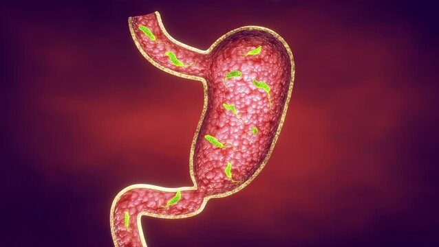 Peptic ulcers are usually caused by an infection of Helicobacter pylori (H. pylori) bacteria. They are open sores on the inner lining of the stomach and the upper part of the small intestine