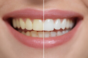 Dental teeth whitening before and after concept
