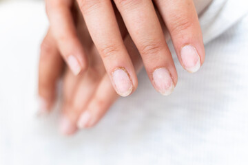 Fototapeta premium Damaged fingernails from gel polish. Hand care. Nail health. Free space.