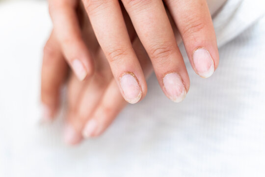 Damaged fingernails from gel polish. Hand care. Nail health. Free space.