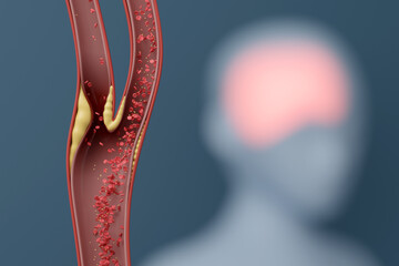 Carotid Artery Blockage Leading to Stroke, Brain Highlighted, 3D Medical Concept
